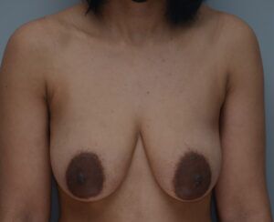 Breast Lift Before & After Patient #1035