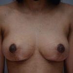 Breast Lift Before & After Patient #1035