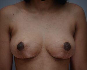 Breast Lift Before & After Patient #1035