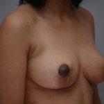 Breast Lift Before & After Patient #1035