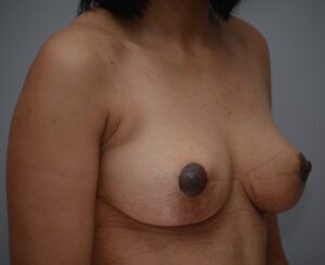 Breast Lift Before & After Patient #1035