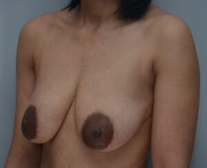 Breast Lift Before & After Patient #1035