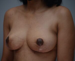Breast Lift Before & After Patient #1035