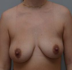 Breast Lift With Implants Before & After Patient #1096