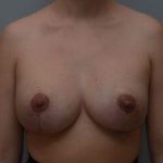 Breast Lift With Implants Before & After Patient #1096