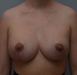 Breast Lift With Implants Before & After Patient #1096
