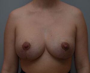 Breast Lift With Implants Before & After Patient #1096