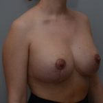 Breast Lift With Implants Before & After Patient #1096
