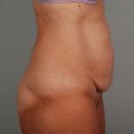 Abdominoplasty Before & After Patient #1330