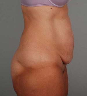 Abdominoplasty Before & After Patient #1330