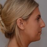 Rhinoplasty Before & After Patient #2115