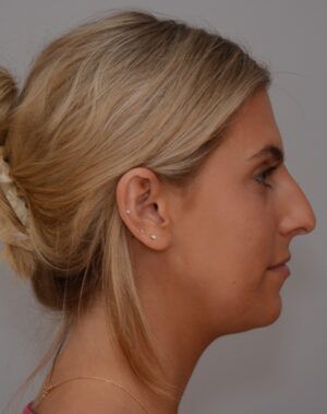 Rhinoplasty Before & After Patient #2115