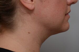 Neck Liposuction Before & After Patient #2008