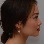 Non-Surgical Rhinoplasty Before & After Patient #2247