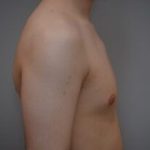 Gynecomastia Before & After Patient #1160