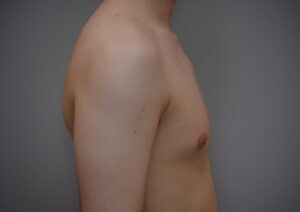 Gynecomastia Before & After Patient #1160