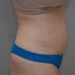 Liposuction with Bodytite Before & After Patient #1558