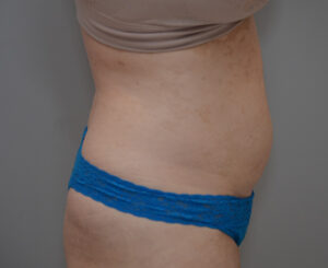 Liposuction with Bodytite Before & After Patient #1558
