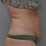 Abdominoplasty Before & After Patient #1496