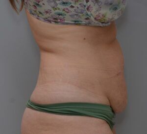 Abdominoplasty Before & After Patient #1496