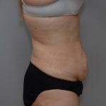 Abdominoplasty Before & After Patient #1495