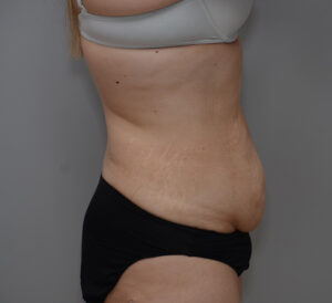 Abdominoplasty Before & After Patient #1495