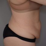 Abdominoplasty Before & After Patient #1494