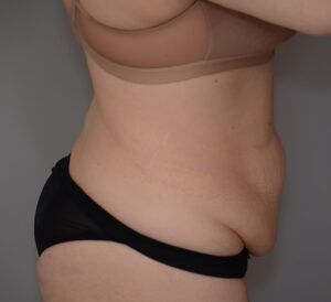 Abdominoplasty Before & After Patient #1494