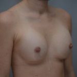 Breast Augmentation Before & After Patient #413