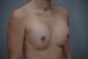 Breast Augmentation Before & After Patient #413