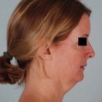 Facelift Before & After Patient #1743