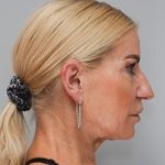 Face And Neck Lift Before & After Patient #1745