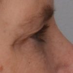 Blepharoplasty Before & After Patient #1704