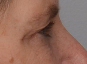 Blepharoplasty Before & After Patient #1704