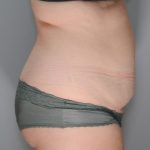 Abdominoplasty Before & After Patient #1271