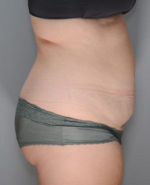 Abdominoplasty Before & After Patient #1271