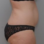 Abdominoplasty Before & After Patient #1387