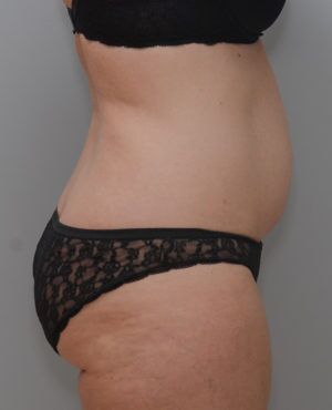 Abdominoplasty Before & After Patient #1387