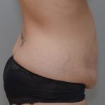 Abdominoplasty Before & After Patient #1440