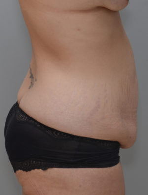 Abdominoplasty Before & After Patient #1440