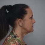 Facelift Before & After Patient #1744