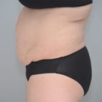 Abdominoplasty Before & After Patient #1210