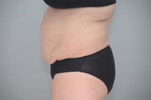 Abdominoplasty Before & After Patient #1210