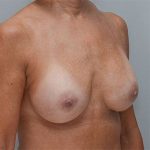 Breast Implant Exchange Before & After Patient #861