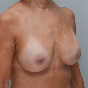 Breast Implant Exchange Before & After Patient #861