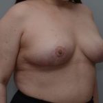 Breast Reduction Before & After Patient #1131