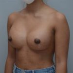 Breast Augmentation Before & After Patient #248