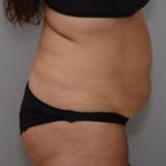 Abdominoplasty Before & After Patient #1443