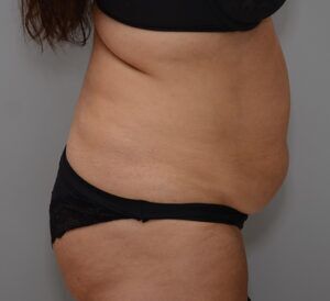 Abdominoplasty Before & After Patient #1443