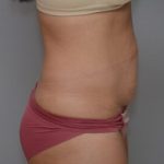 Abdominoplasty Before & After Patient #1442